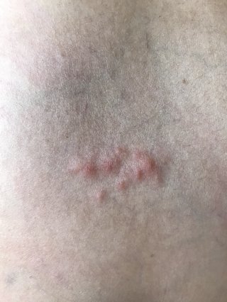 腰に出来た発疹、なんだろ。