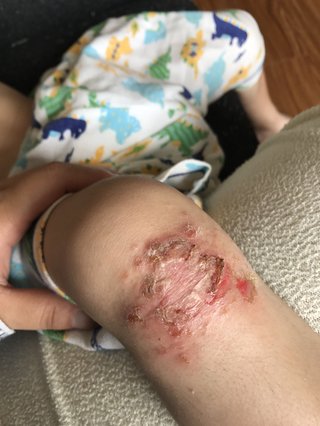 グロ注意 子供の怪我の治し方について