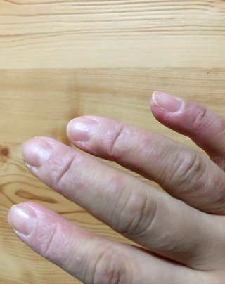 主婦湿疹荒れすぎて指が曲がらない