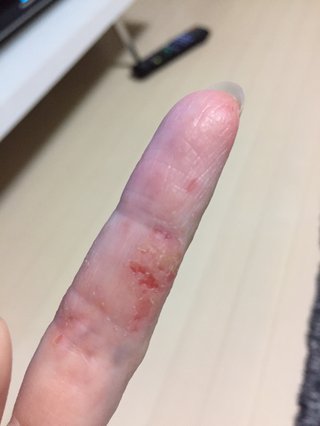 主婦湿疹荒れすぎて指が曲がらない