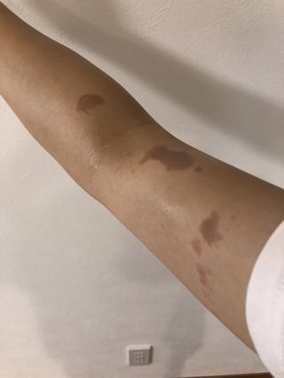 油が腕にはねた。