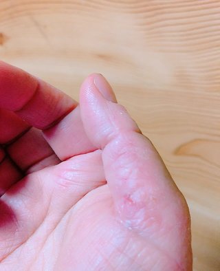 主婦湿疹荒れすぎて指が曲がらない
