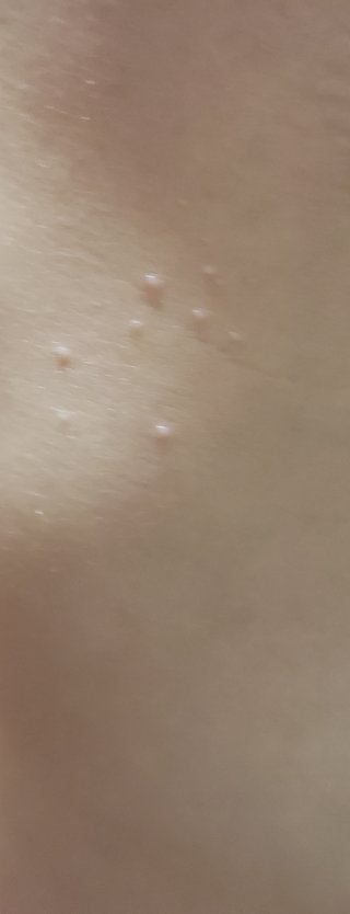 これ水いぼかな？！