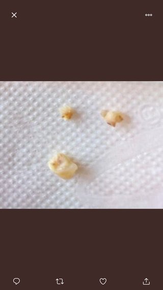 マック マフィンに歯？が混入