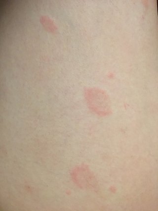 何週間からまえから出てる輪っか状の湿疹