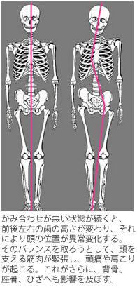 偏頭痛の人、今日どう？