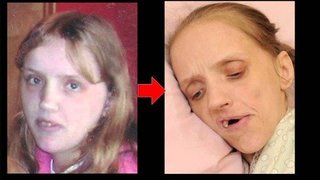 ビールだけしか飲まない女性、かなりえずき、やせたかなしい姿に