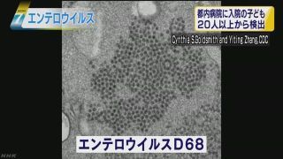 子どもが感染し手足などまひ「急性弛緩性麻痺」に注意を