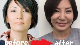 広瀬香美って整形失敗したの？