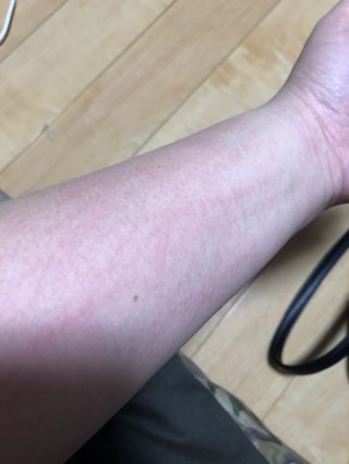 ゴムアレルギー？