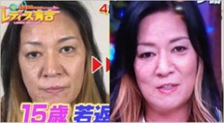 ジャガー横田がやってた若返り治療(200万)やりたい…