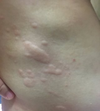 2歳蕁麻疹？