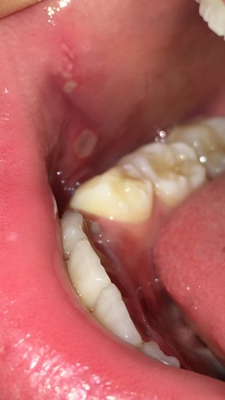 繰り返す子供の口内炎