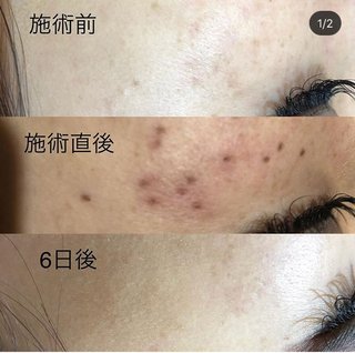 シミデトックスと光脱毛どっちやりたい？