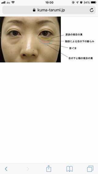 目の下のたるみ