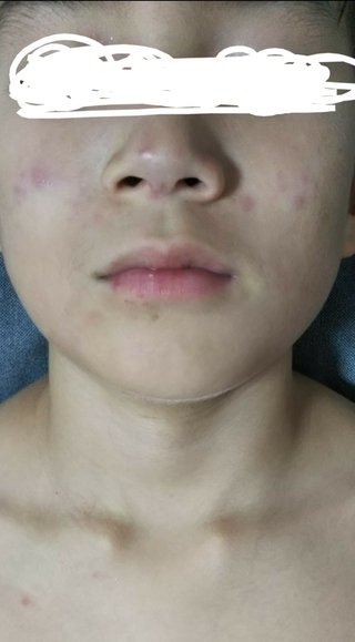 顔だけに発疹？