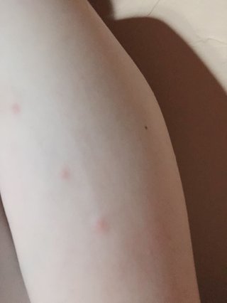 赤い点の虫刺されですっごいかゆいやつ何！？写真あり
