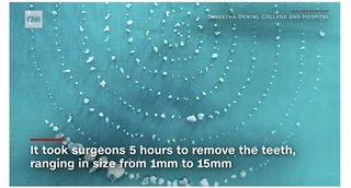 【海外】インド　７歳児の口内に歯が５２６本、摘出手術 