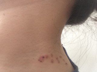 レーザー治療してきました