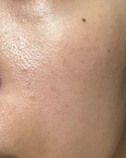 閲覧注意！私より肌が汚い人って見たことないかも