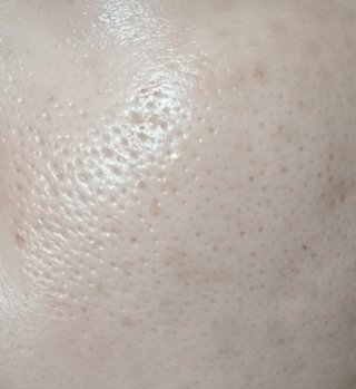 閲覧注意！私より肌が汚い人って見たことないかも