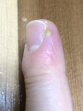 指に膿み？ができて腫れて痛い