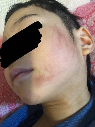 【京都】3歳の保育園児、研磨スポンジで頬こすられやけど　右京