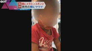 【京都】3歳の保育園児、研磨スポンジで頬こすられやけど　右京