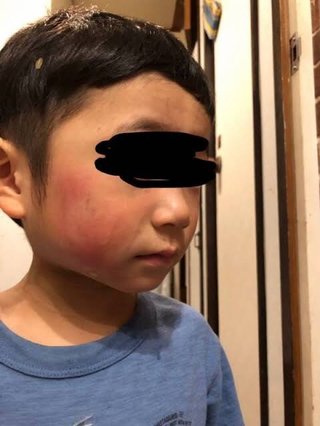 【京都】3歳の保育園児、研磨スポンジで頬こすられやけど　右京