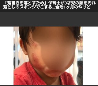 【京都】3歳の保育園児、研磨スポンジで頬こすられやけど　右京