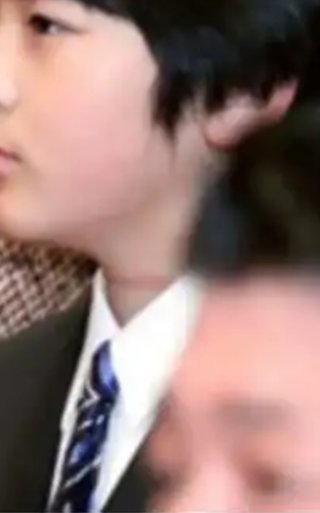 悠仁さまの首にできた謎のアザ