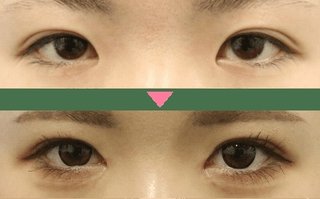 目頭切開するとこれがこうなります