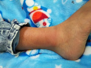 8歳男子、身に覚えのない足の痛みと腫れ