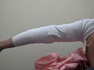 今から脂肪吸引の施術受けます！！