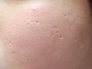 ニキビ跡【クレーター】治るか実験∩'∀'∩