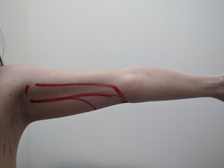 今から脂肪吸引の施術受けます！！