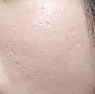 ニキビ跡【クレーター】治るか実験∩'∀'∩