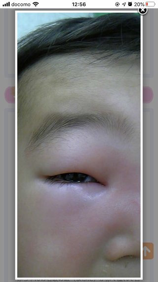 何科でしょうか？2歳目の周りの腫れと赤み