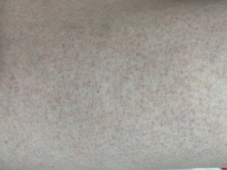 【閲覧注意】太腿内側に赤い斑点？