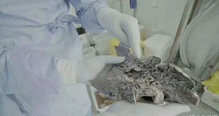 コロナ、重症患者の肺だって
