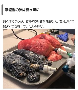 コロナ、重症患者の肺だって