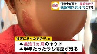 園児の顔『メラミンスポンジ』でこすり、やけど負わせた元保育士を書類送検
