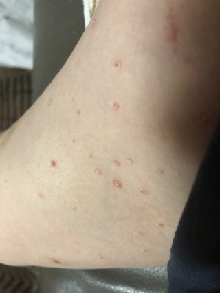 二の腕の内側のポツポツ