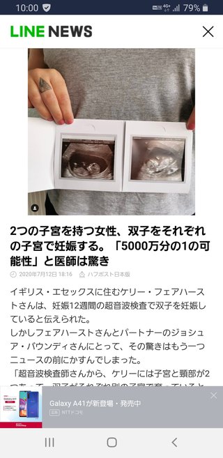 2つの子宮を持つ女性、双子をそれぞれの子宮で妊娠
