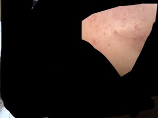 私の頬やばくない？マスク荒れ