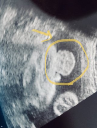 32w エコーで女の子→男の子