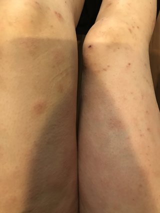 頭皮が痒い！！