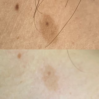 やっぱりハイドロキノンとトレチノインって凄いね。汚写あり