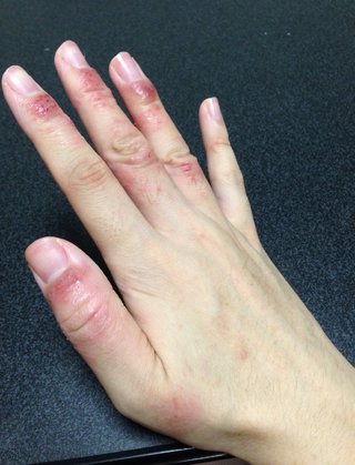 頭皮が痒い！！