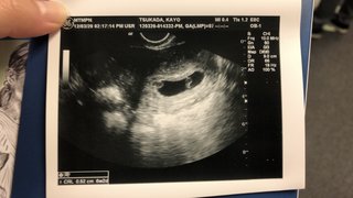 双子？ポリープ？